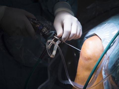 knee arthroscopy in Dwarka