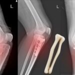 Tibia Fibula Fracture treatment ortho doctor delhi